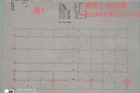 间歇性预激综合征图片
