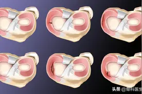 膝关节半月板损伤能自愈吗？图片