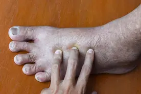 一肢脚肿了怎么回事？常见原因解密图片