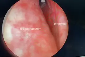 前列腺增生有饮食疗法吗？有食谱吗？有，但要注意食疗不是药图片
