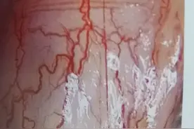 解开经络的千古之谜15——筋膜性活血图片