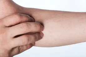过敏性血管炎的主要症状有哪些？这2点要知晓图片