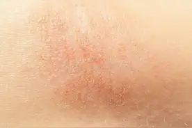 怎样辨别湿疹图片