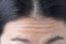 抬头纹太重怎么办？教你4个小技巧，让抬头纹消失得无影无踪图片
