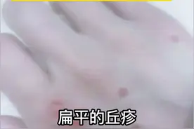手上冒出疙瘩，还越长越多？还长到脸上？那可能是传染了图片