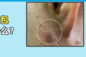 耳朵长了一个硬硬的包，该怎么治疗？图片