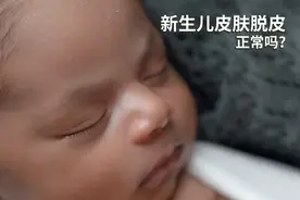 新生儿皮肤脱皮，正常吗？图片