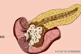 “癌中之王”——胰腺癌的正确饮食方法图片