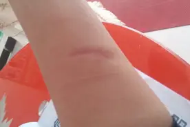 缝针完要注意什么？听听医生的意见图片
