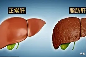 脂肪肝？只治肝可不行 教你一个方 疏肝健脾 标本兼治 降脂化浊图片