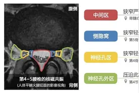 什么是椎管狭窄症？常见治疗方法有哪些？图片