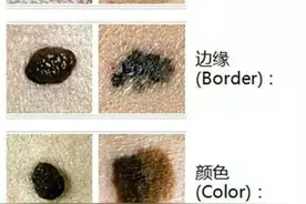 身上这些痣别乱点，可能会致癌图片