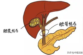 张仲景千年古方，化解胆结石、胆囊炎、胆息肉，攻补兼施 标本兼治图片