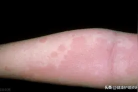 荨麻疹的护理图片