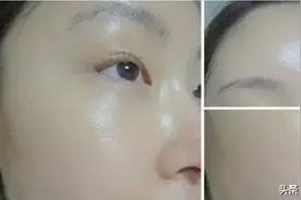 作为“做过水光针”的过来人，我来告诉你几个真相图片