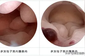 滴滴答答不干净，可能是这个地方长息肉了图片