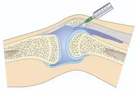 骨科必看的科普｜| 关于“局部封闭疗法“的大众误区，你避雷了吗图片