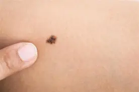 身上这3个部位出现黑痣，有5种异常表现时，可能是癌症发出的信号图片