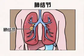 肺结节到底能不能吃大虾？不想结节恶化，4种食物，尽量少碰图片