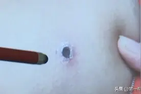 女子高烧不退致多器官衰竭，原是虫子惹的祸？医生：患恙虫病图片