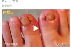 疼疼疼！甲沟炎，多是因为剪指甲习惯错了图片