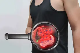 肝病患者，饮食要忌口，这6类食物要少碰，以免加重肝脏损伤图片