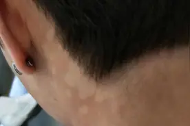 一到夏季，后背长了一些褐色的斑点，这是什么皮肤病？图片