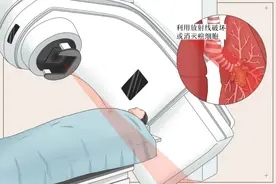 放疗的4种方式及临床应用图片