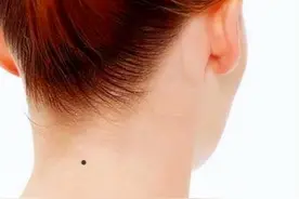 为什么有些人脖子后面都有一颗“痣”？是好是坏？或许不只是巧合图片