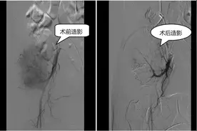 让我们一起认识介入医学 ——周围血管介入图片