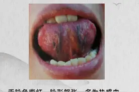 舌下血管又黑又粗，多是瘀血作怪，一个中成药搭配 ，化尽一身瘀血图片