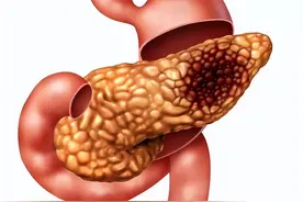 胰腺癌是癌症之“王”，哪些事情少做，对胰腺有好处？医生告诉你图片