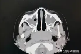 孩子反复咳嗽、鼻塞、流脓性鼻涕，以为是“感冒”？ 这都是鼻窦炎惹的祸！图片