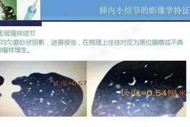 肺结节就是肺癌？图片