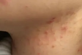 脖子上长痘痘怎么办？图片