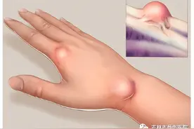 一招解决腱鞘囊肿图片