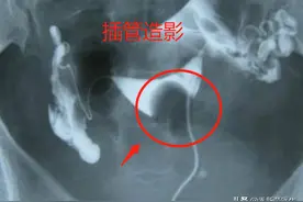 做过造影后多久可以要孩子？图片