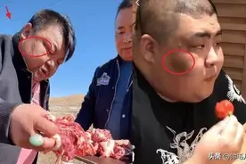 脸上长了一块黑斑，去医院检查后，我当天就住院了图片