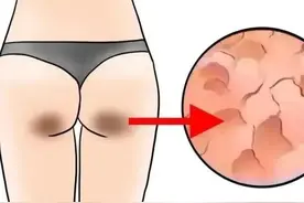 屁屁上两团黑黑的是怎么回事图片