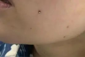 细思极恐！为了长酒窝，竟有人在脸上打了两颗钉子图片