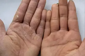 手脱皮、长手癣是怎么引起的？如何治疗好得快？遵循这4点图片