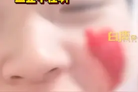 男生挤痘血流不止近1小时，当事人：用了400张抽纸，整个脸都苍白了；专家：自行挤压容易造成严重感染图片