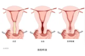 绝经后宫腔积液需不需要处理？图片