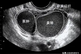 12岁女生肚子隆起爬满“妊娠纹”，照完CT妈妈吓懵，比怀孕更可怕图片