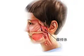 腺样体面容长什么样？怀疑腺样体肥大怎么办图片