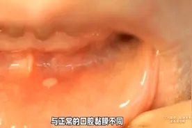 你知道口腔溃疡为什么是白色的吗？#科普一下图片
