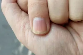 指甲盖上有竖纹，是咋回事？真是老人说的“肝脏不好”吗？了解下图片