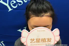 “植”得期待的植发反馈，和你想象的一样吗？后悔了吗？图片