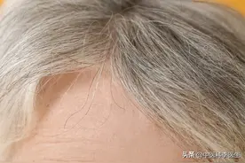 为什么白头发越来越多？不一定是老了，医生：可能缺乏4种营养素图片