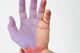 腕管综合征分轻度，中度，重度，都是什么感觉，又该怎么治？图片